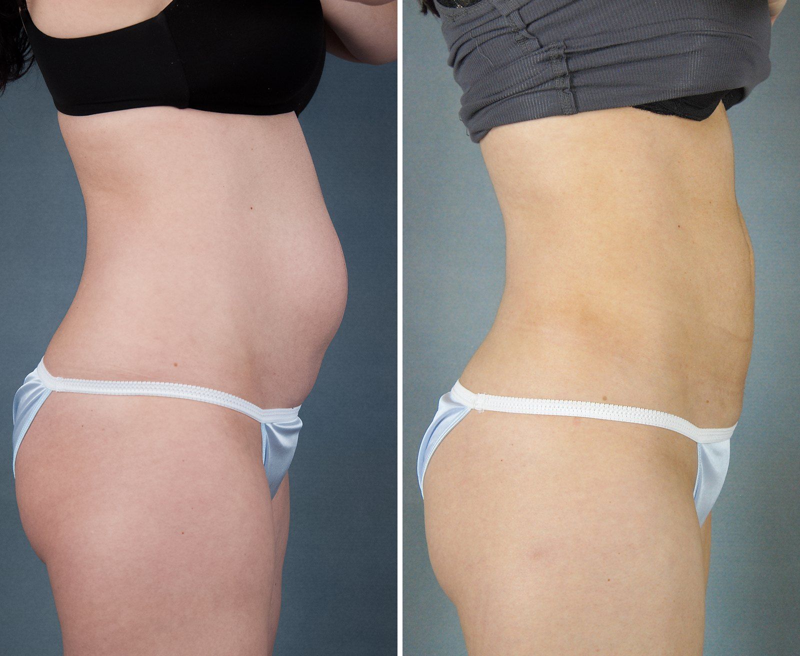 Before and after SenzaLipo: Abdomen. Before on the left, after on the right.