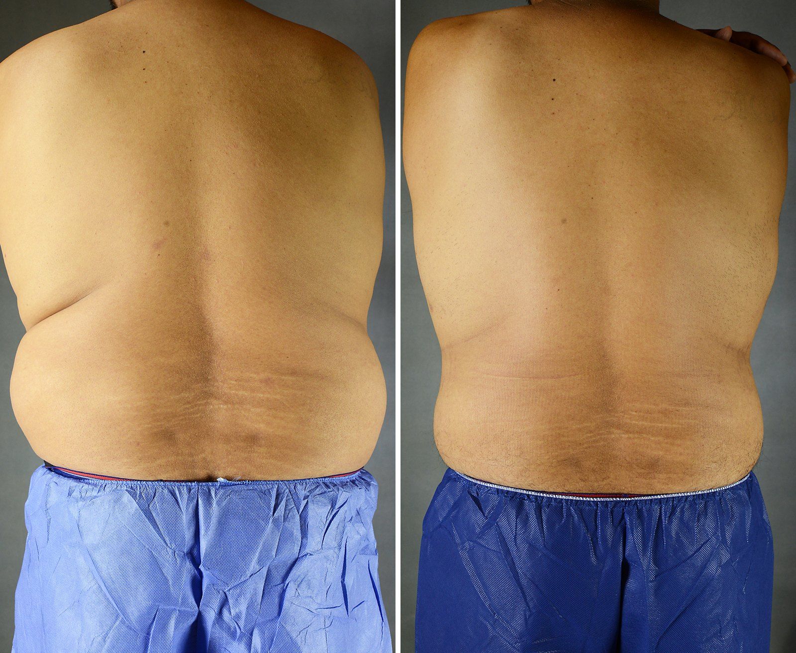 Before and after SenzaLipo: Back & flanks. Before on the left, after on the right.