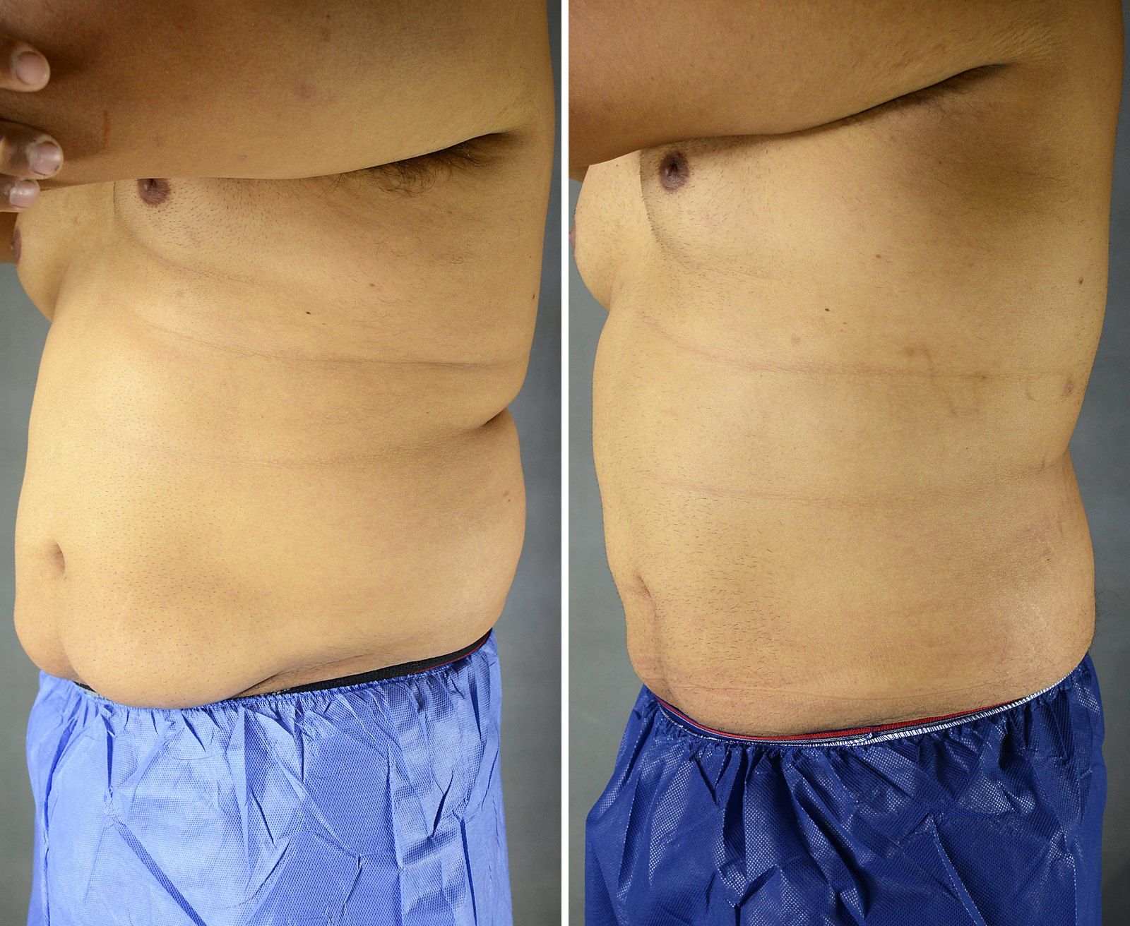 Before and after SenzaLipo: Abdomen & flanks. Before on the left, after on the right.