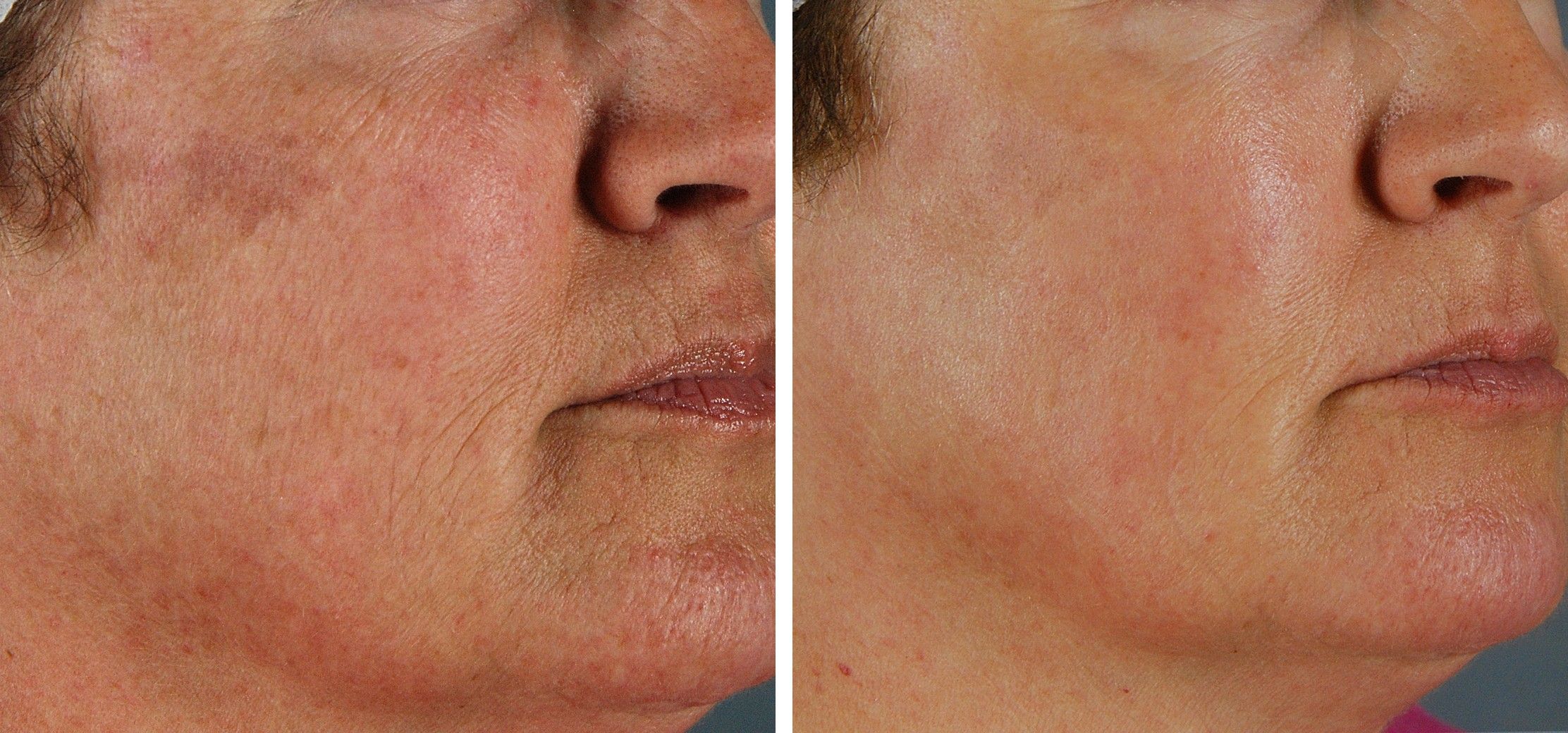 Close-up of a cheek before and after SenzaLux: a brown patch and blotchy redness are clearly lighter and more even afterward