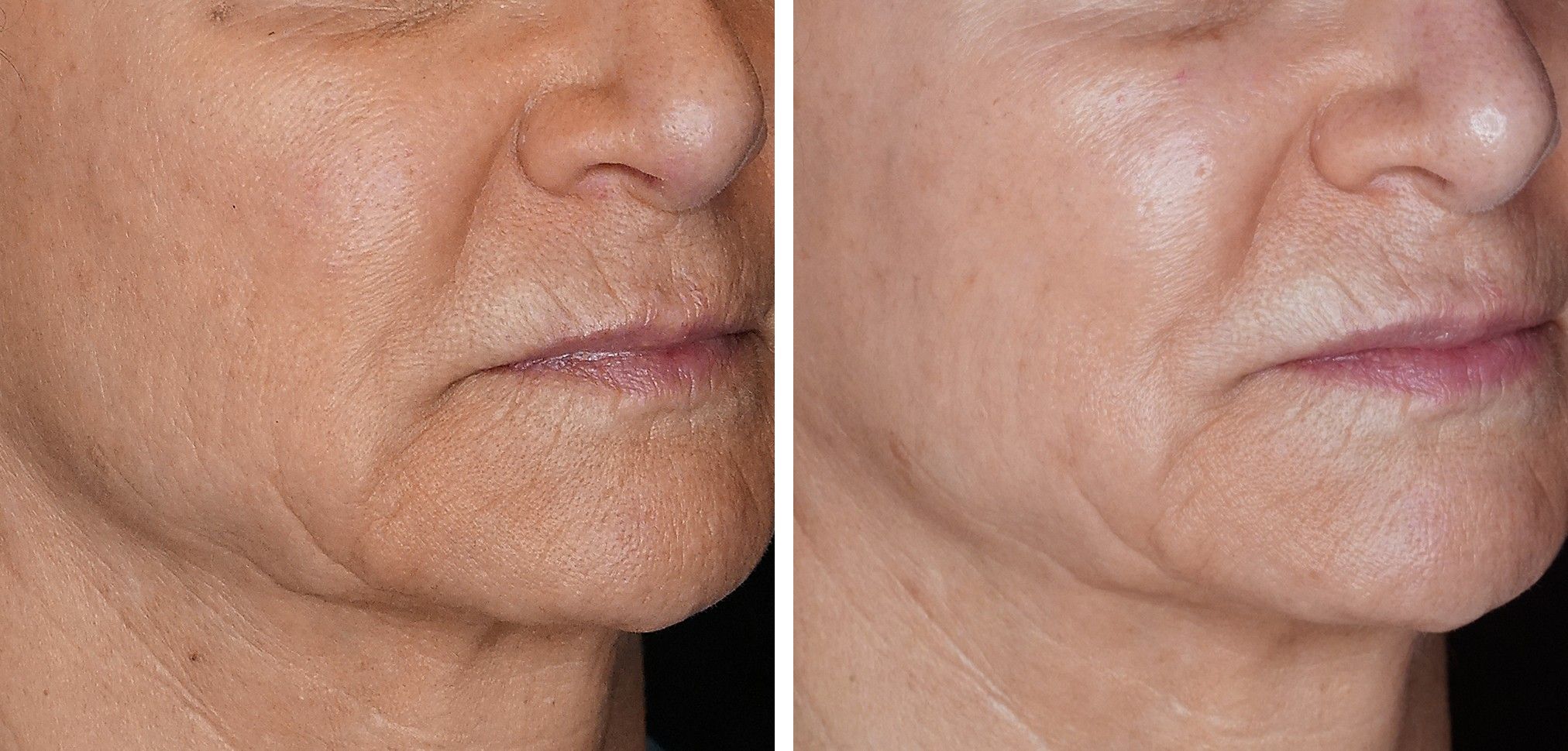 Close-up of the lower face before and after SenzaLux: skin tone is more even and texture and fine lines are softer afterward