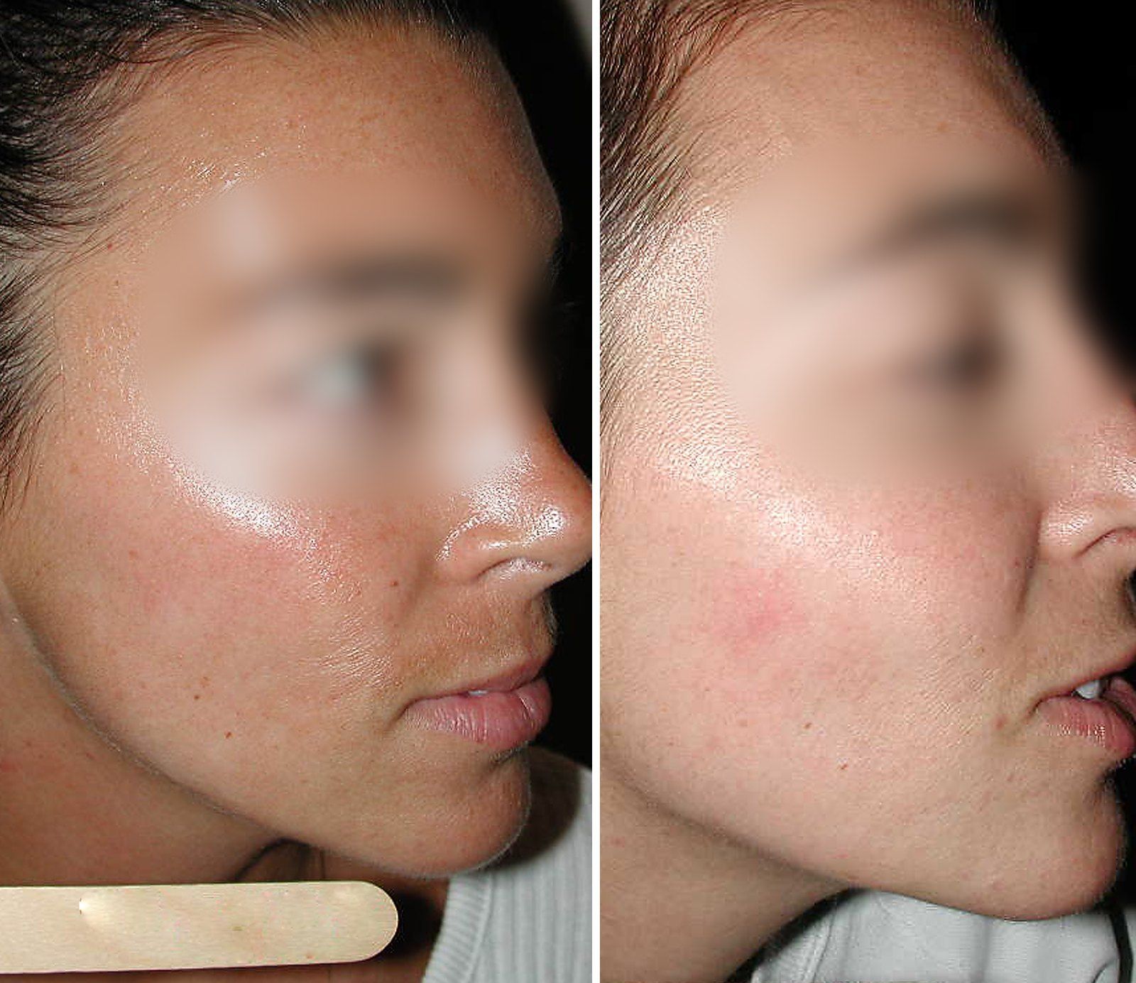 Before and after Obagi skin care. Before on the left, after on the right.