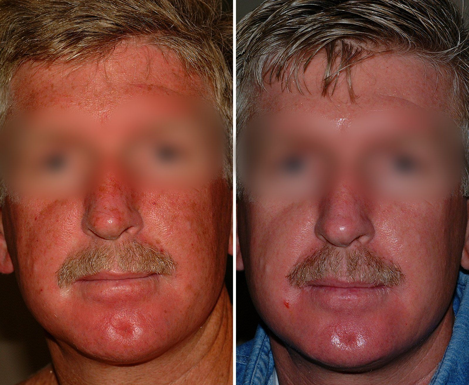 Before and after Obagi skin care. Before on the left, after on the right.