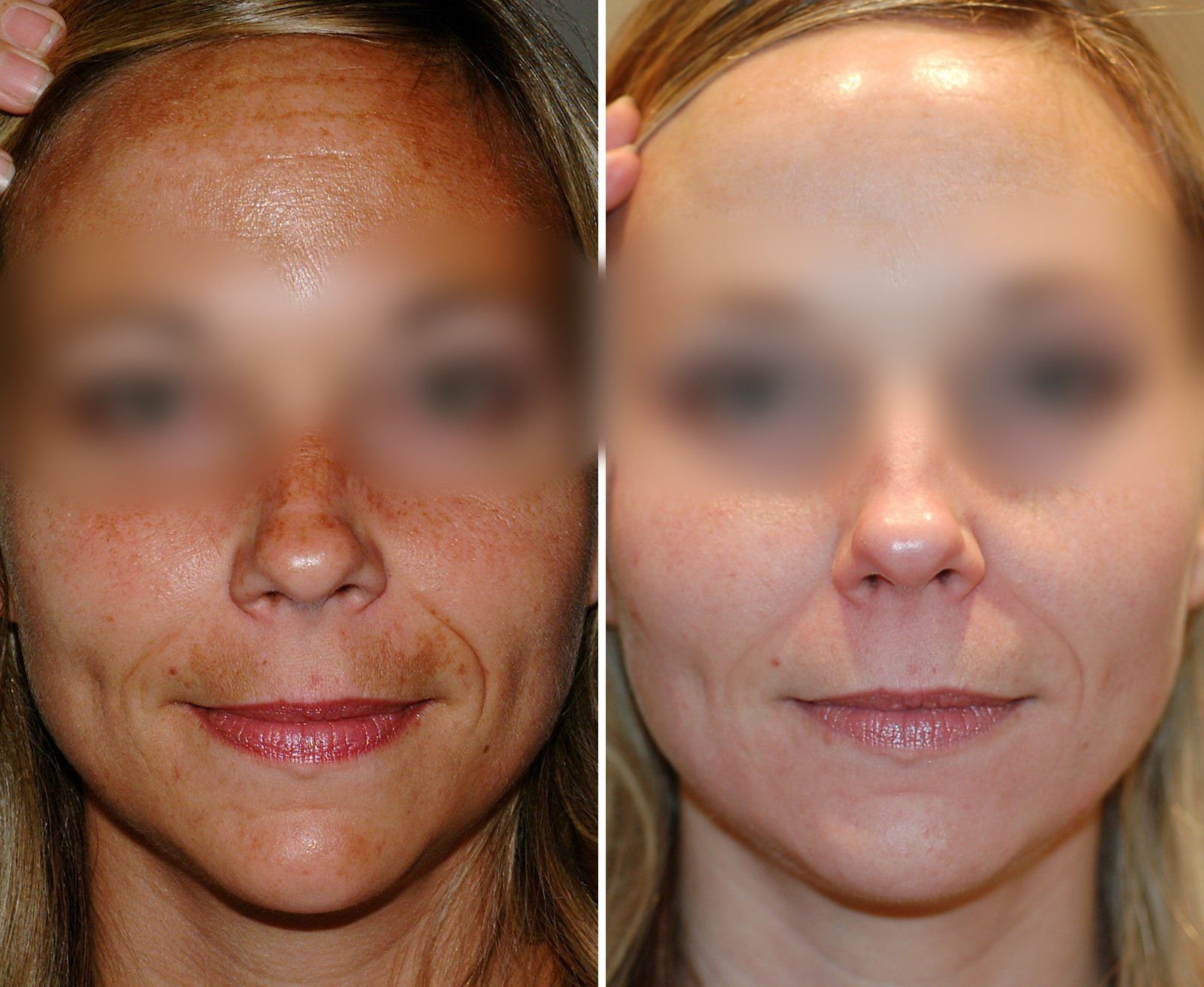 Before and after Obagi skin care. Before on the left, after on the right.