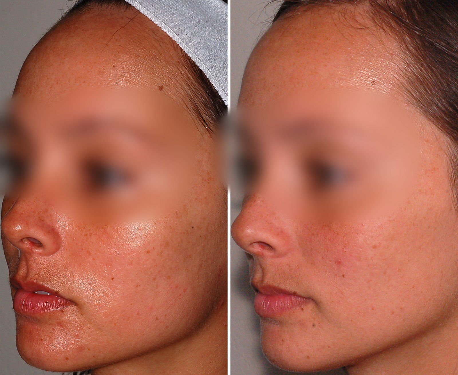 Before and after Obagi skin care. Before on the left, after on the right.