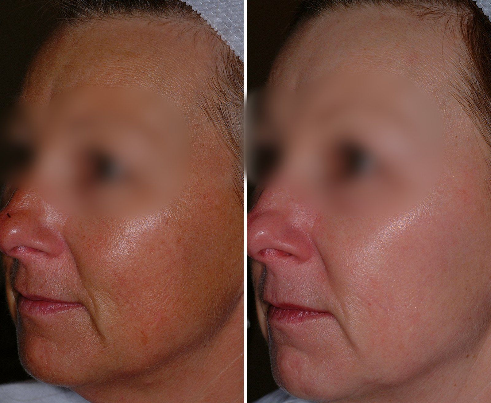 Before and after Obagi skin care. Before on the left, after on the right.
