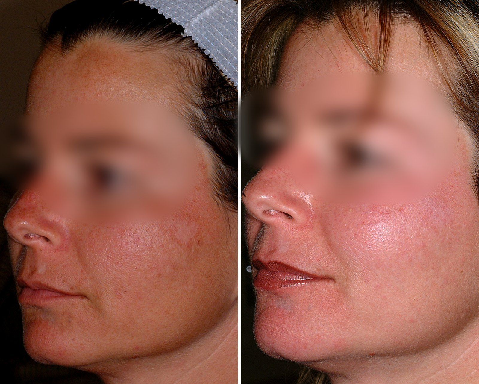 Before and after Obagi skin care. Before on the left, after on the right.