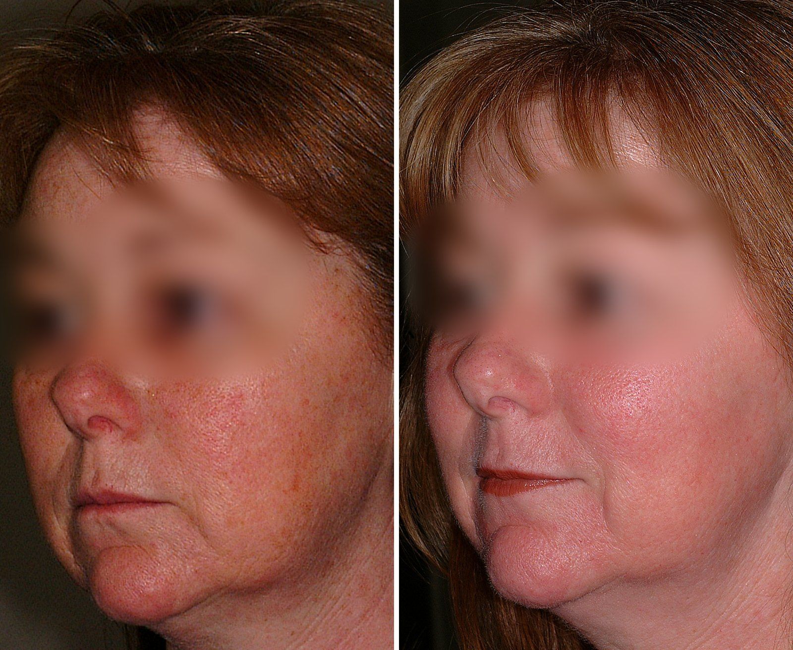 Before and after Obagi skin care. Before on the left, after on the right.