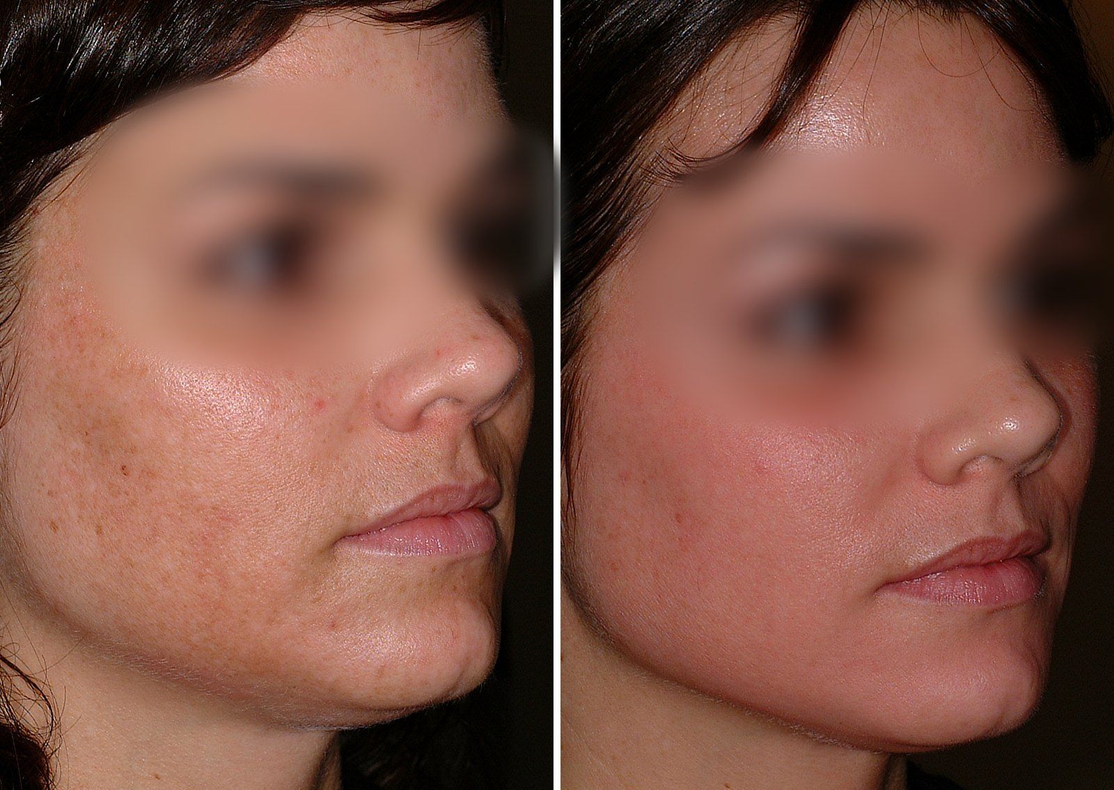 Before and after Obagi skin care. Before on the left, after on the right.