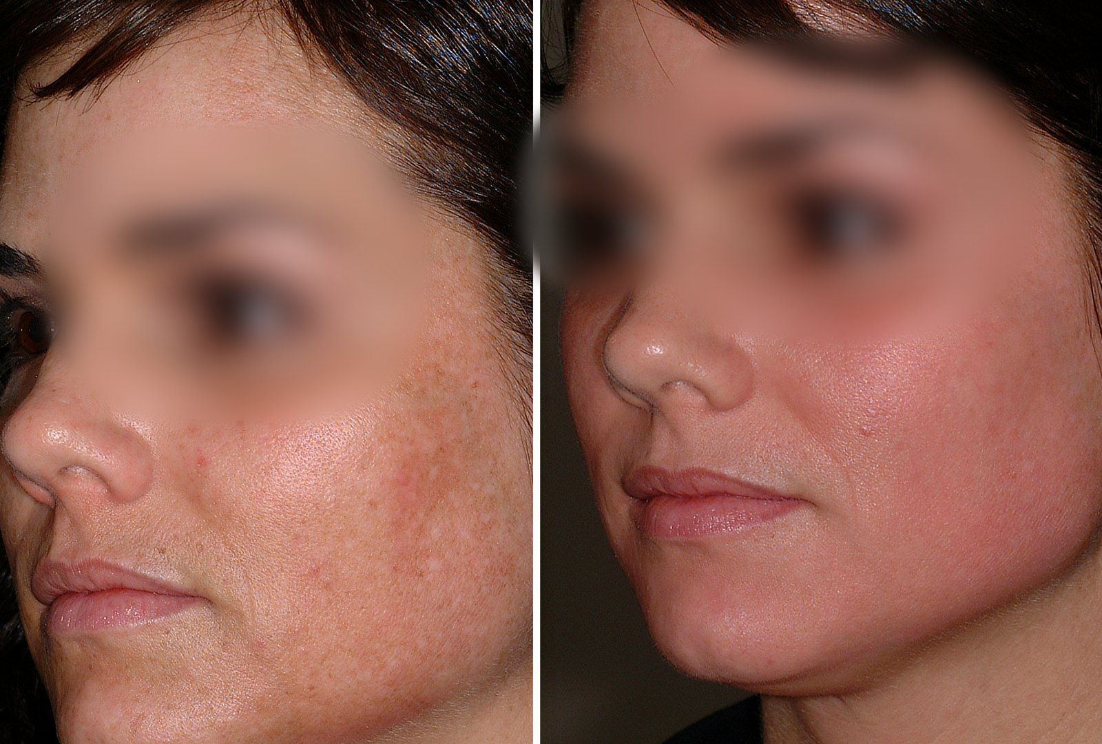Before and after Obagi skin care. Before on the left, after on the right.