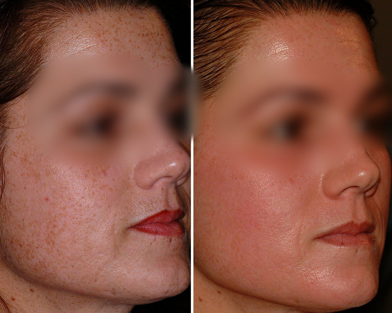 Before and after Obagi skin care. Before on the left, after on the right.