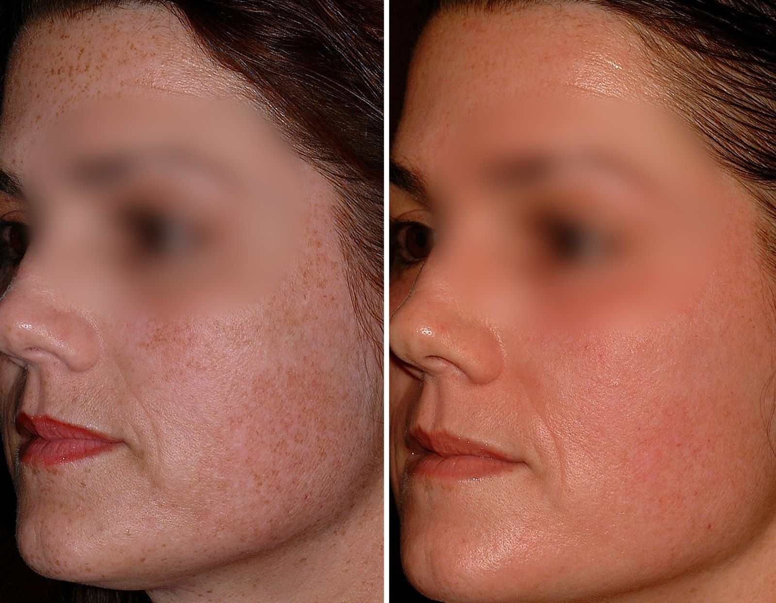 Before and after Obagi skin care. Before on the left, after on the right.