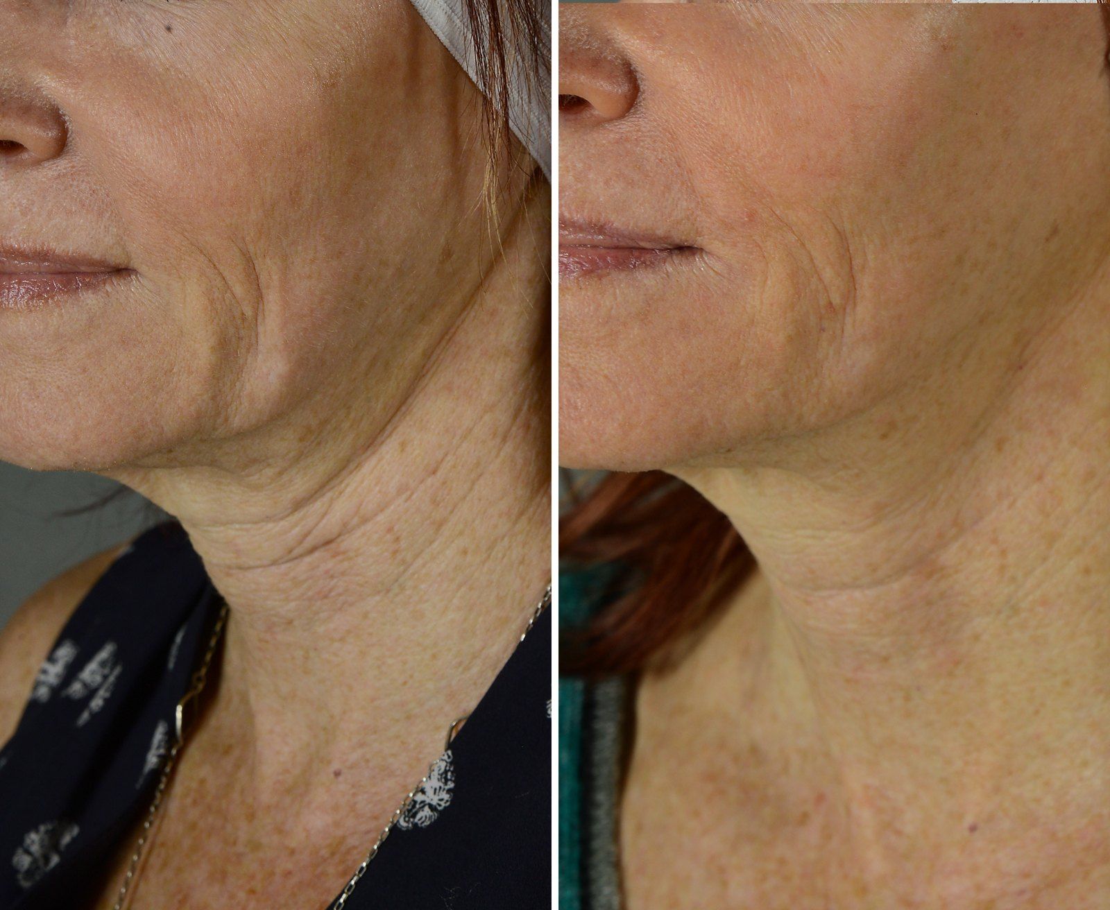 Before and after Skin tightening: Neck, 2 Exilis and 1 fractional resurfacing. Before on the left, after on the right.