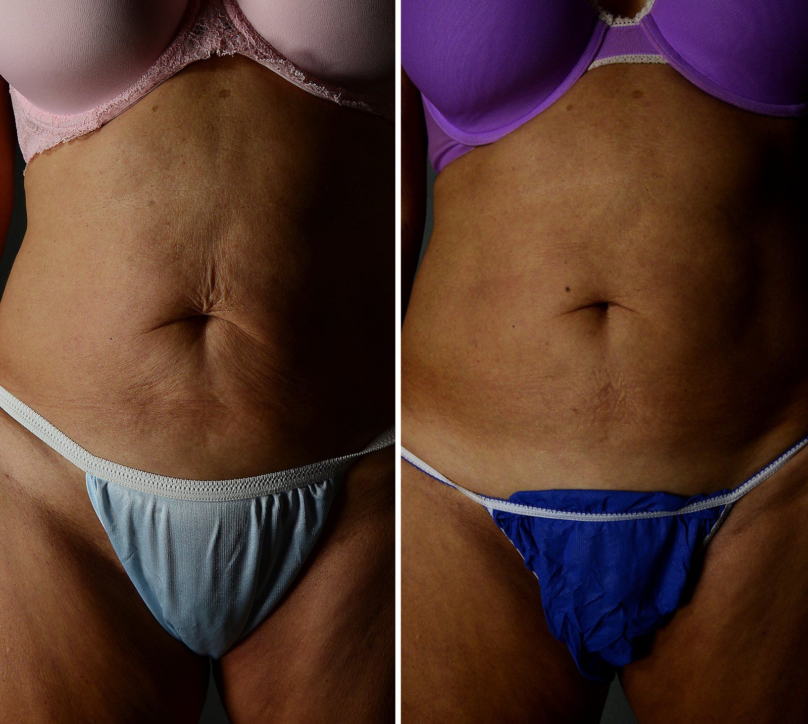 Before and after Skin tightening: Abdomen, 6 Exilis treatments. Before on the left, after on the right.