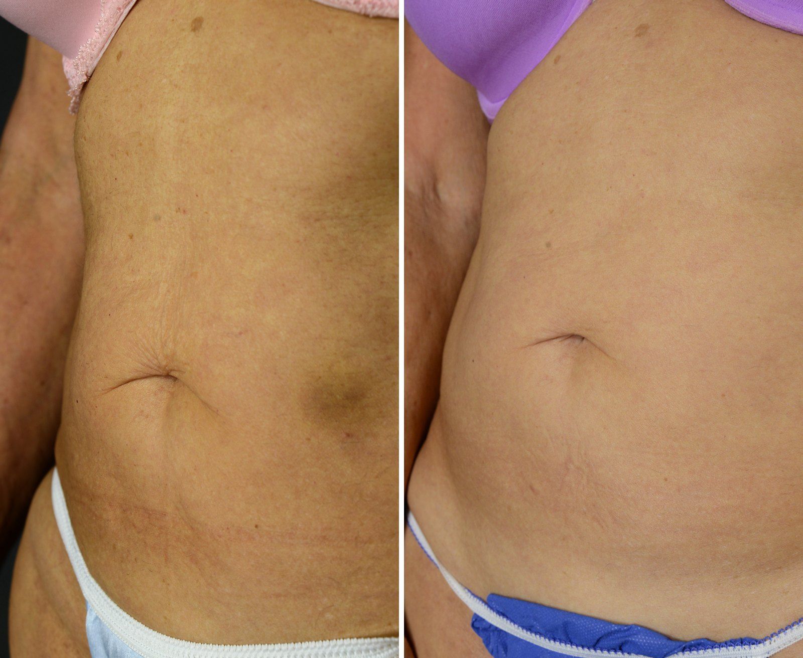 Before and after Skin tightening: Abdomen, 6 Exilis treatments. Before on the left, after on the right.
