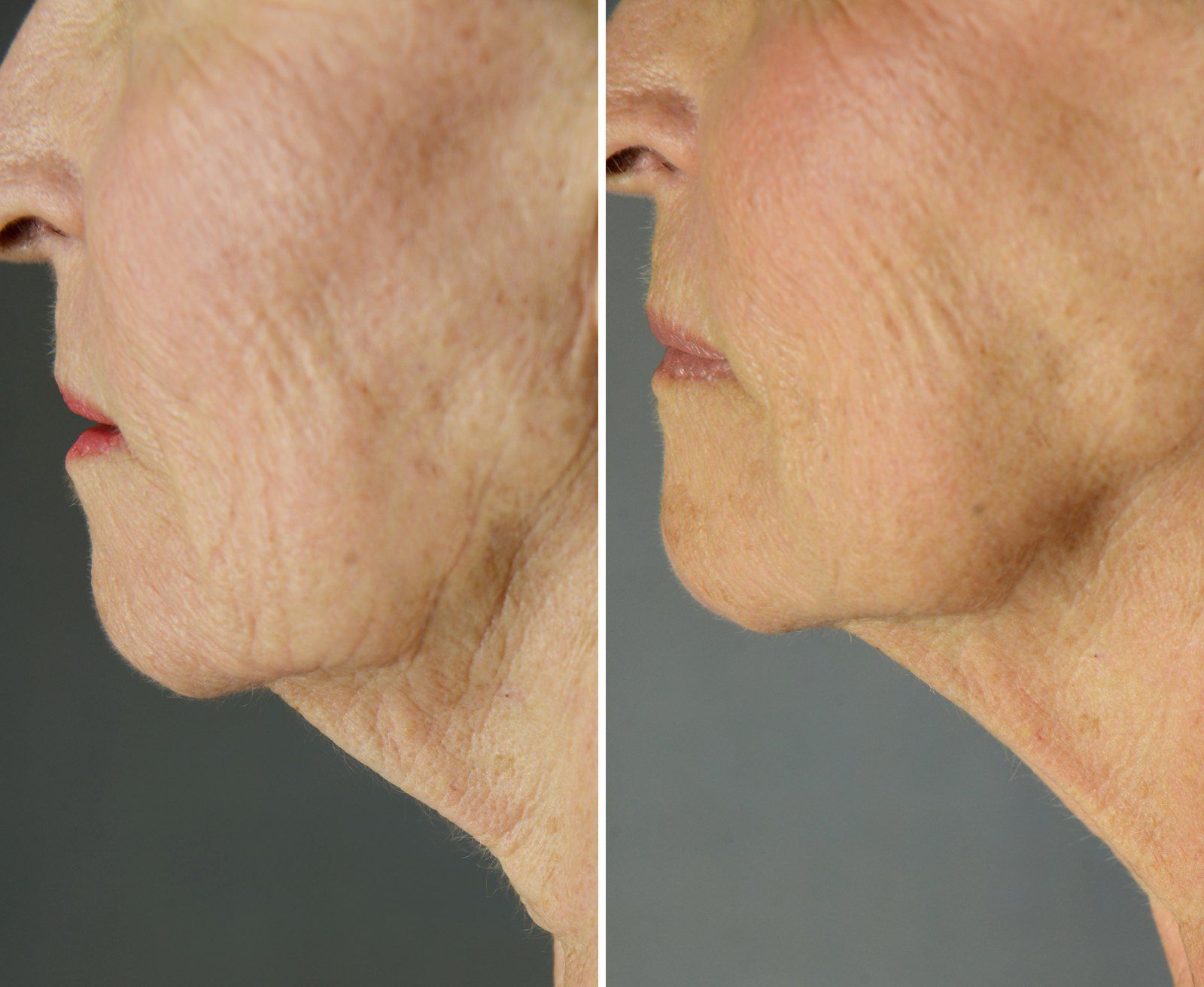 Before and after Skin tightening: Jawline & neck, 4 Exilis treatments. Before on the left, after on the right.
