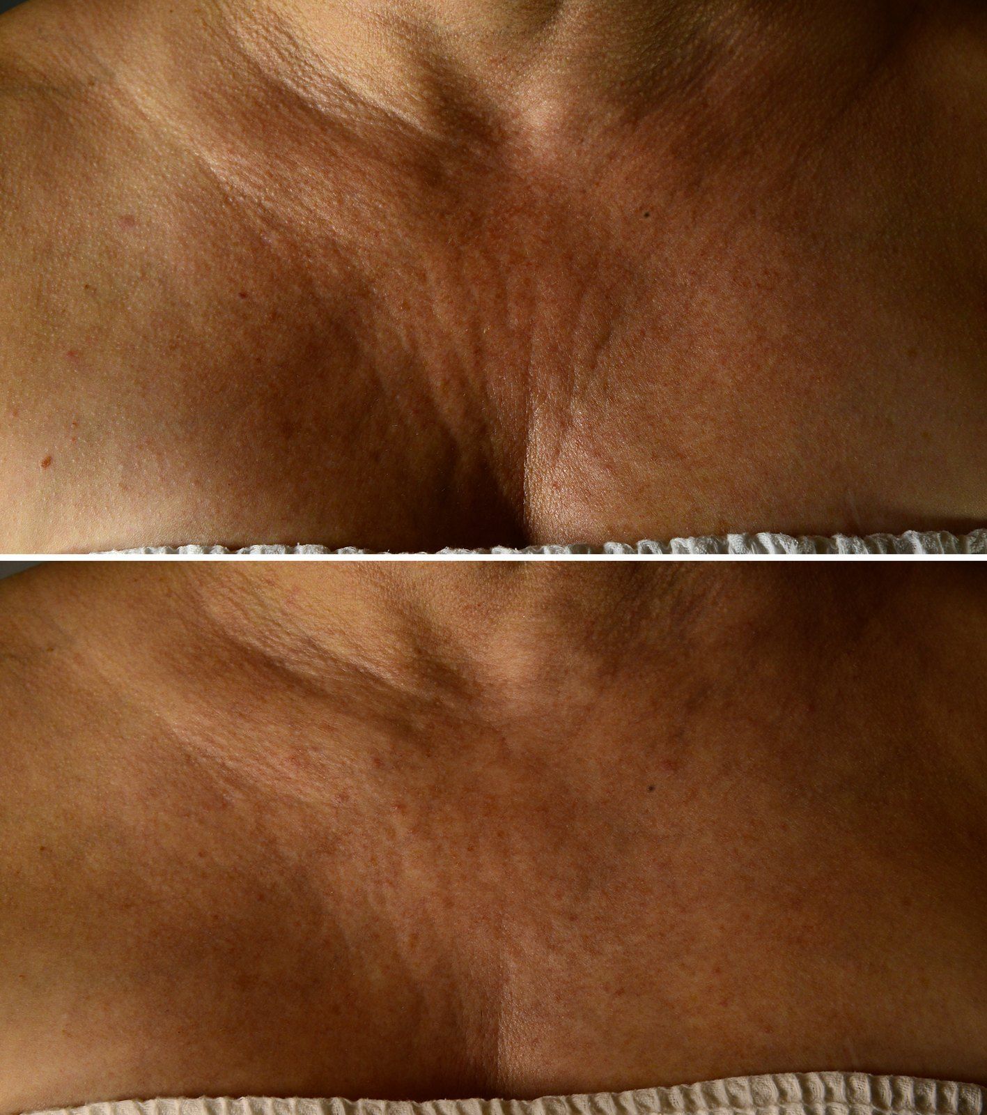 Before and after Skin tightening: Chest, Exilis and Laser Genesis. Before on the top, after on the bottom.
