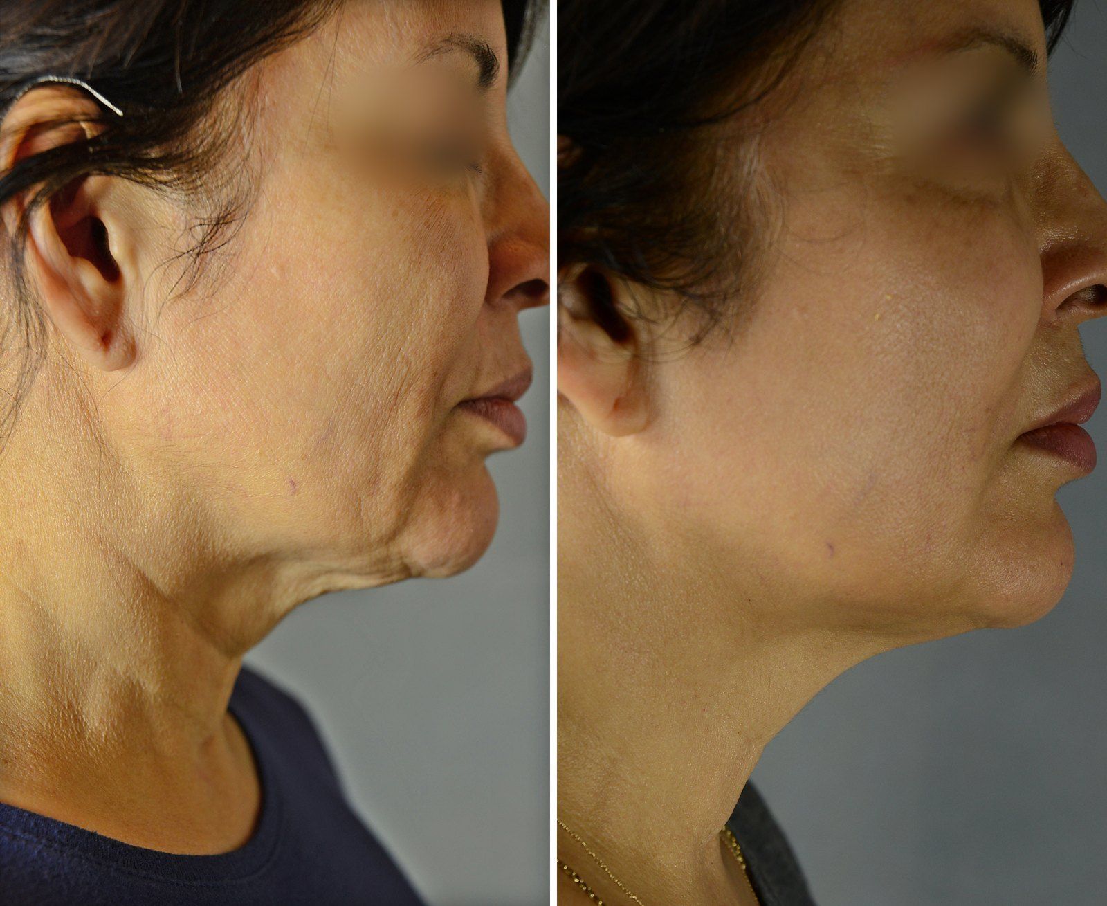 Before and after Skin tightening: Jawline & neck, 4 Exilis treatments. Before on the left, after on the right.