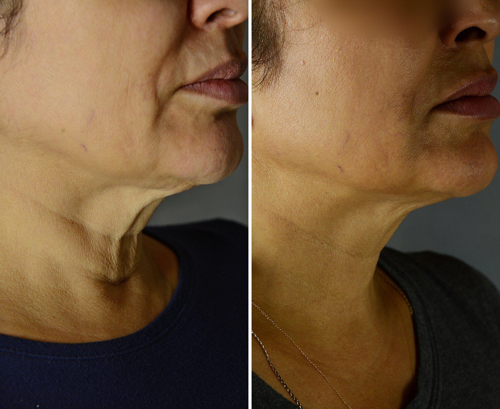 Before and after Skin tightening: Neck, 4 Exilis treatments. Before on the left, after on the right.
