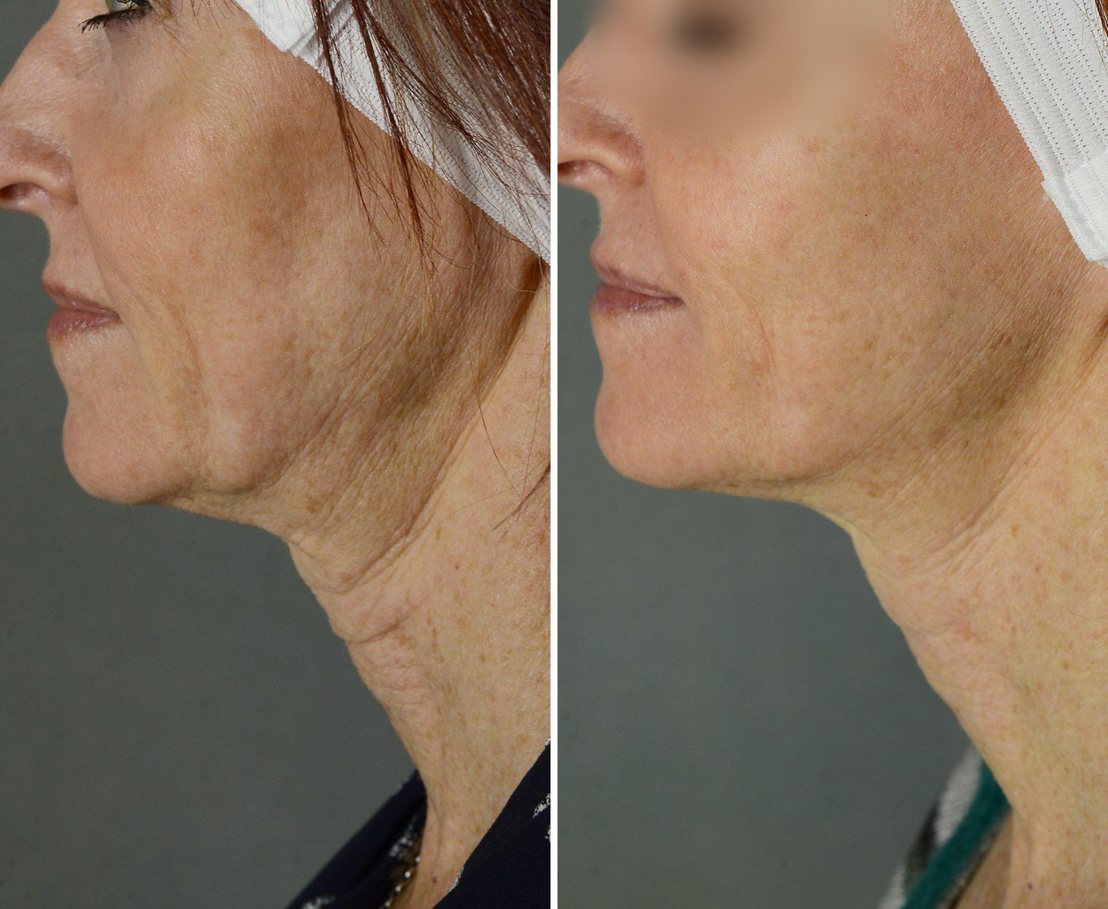 Before and after Skin tightening: Neck, 2 Exilis and 1 fractional resurfacing. Before on the left, after on the right.
