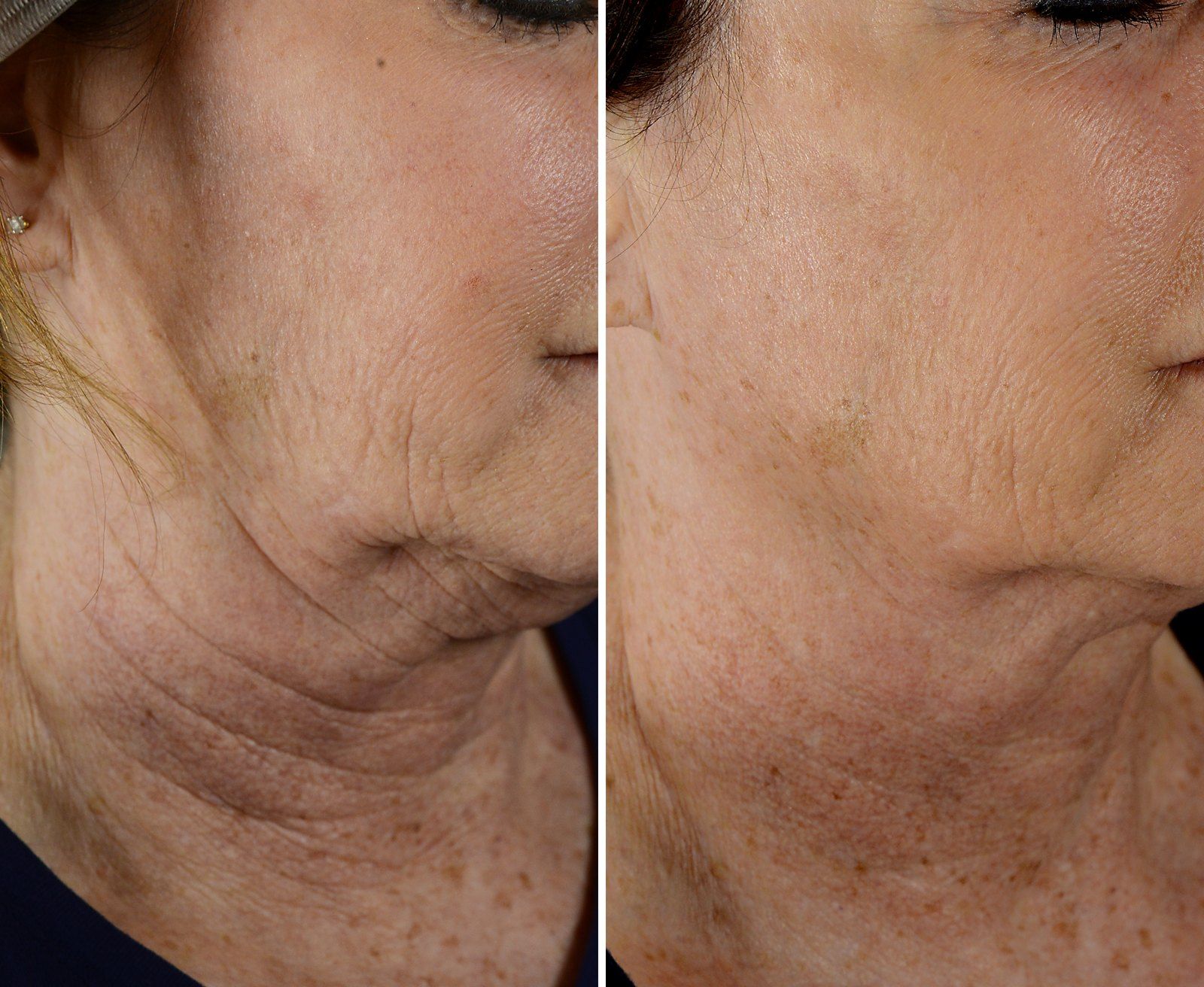 Before and after Skin tightening: Neck, 4 Exilis treatments. Before on the left, after on the right.