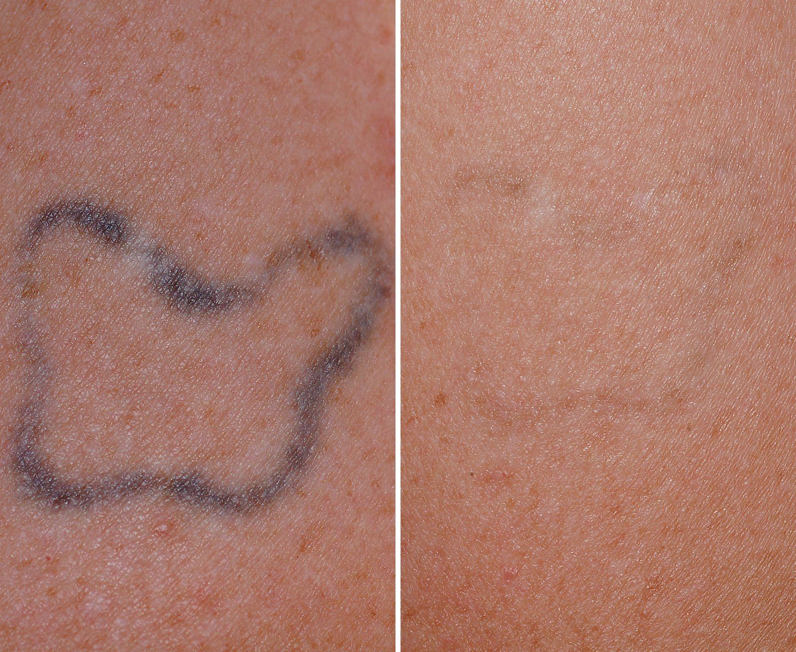 Tattoo Removal before and after