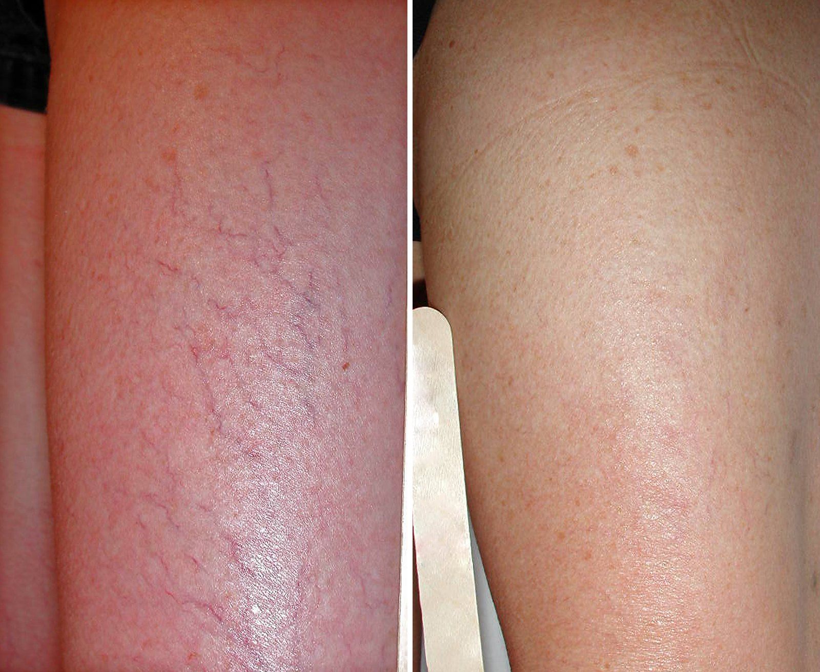 Before and after Vein treatment: Leg veins. Before on the left, after on the right.