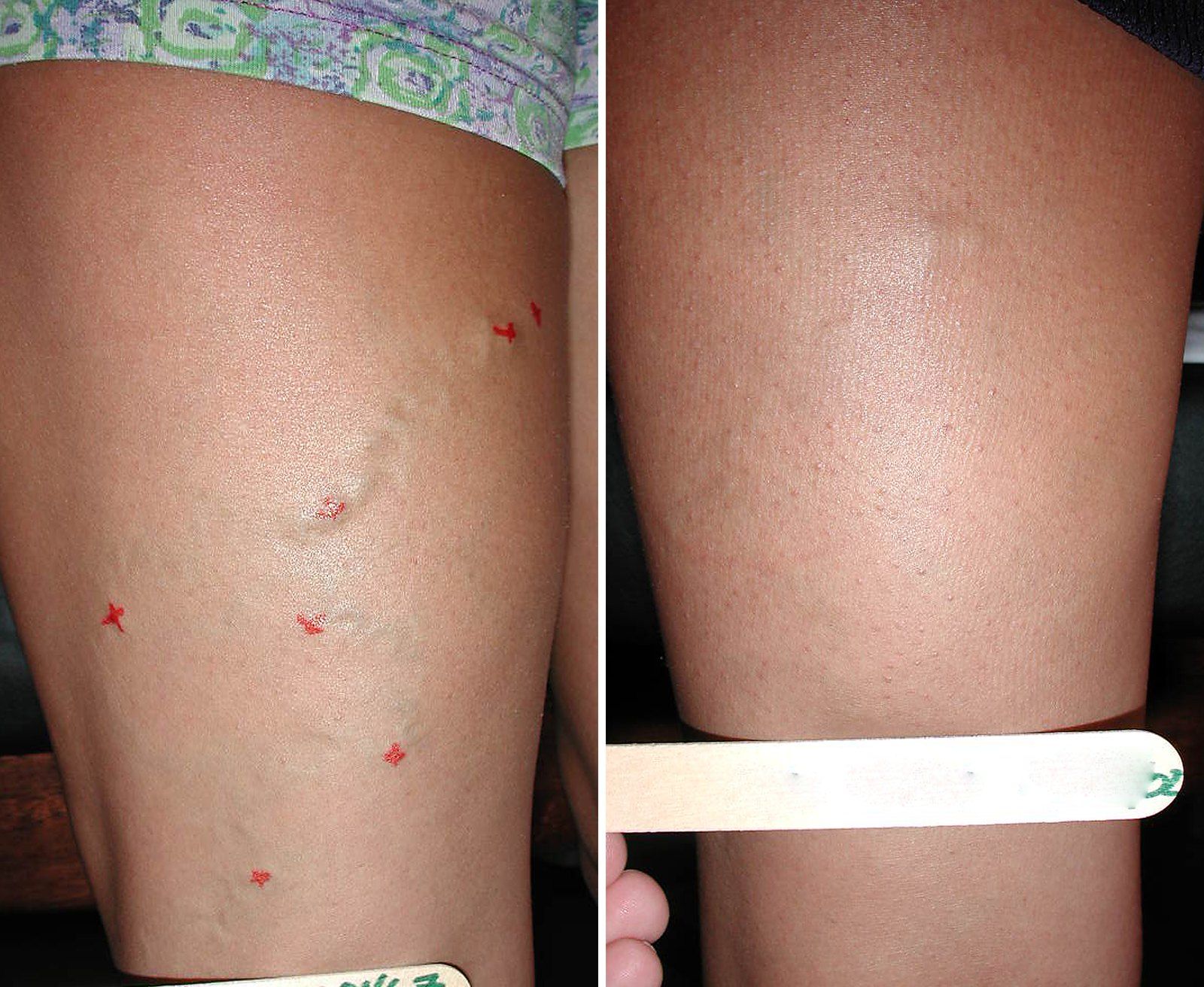 Before and after Vein treatment: Leg veins. Before on the left, after on the right.