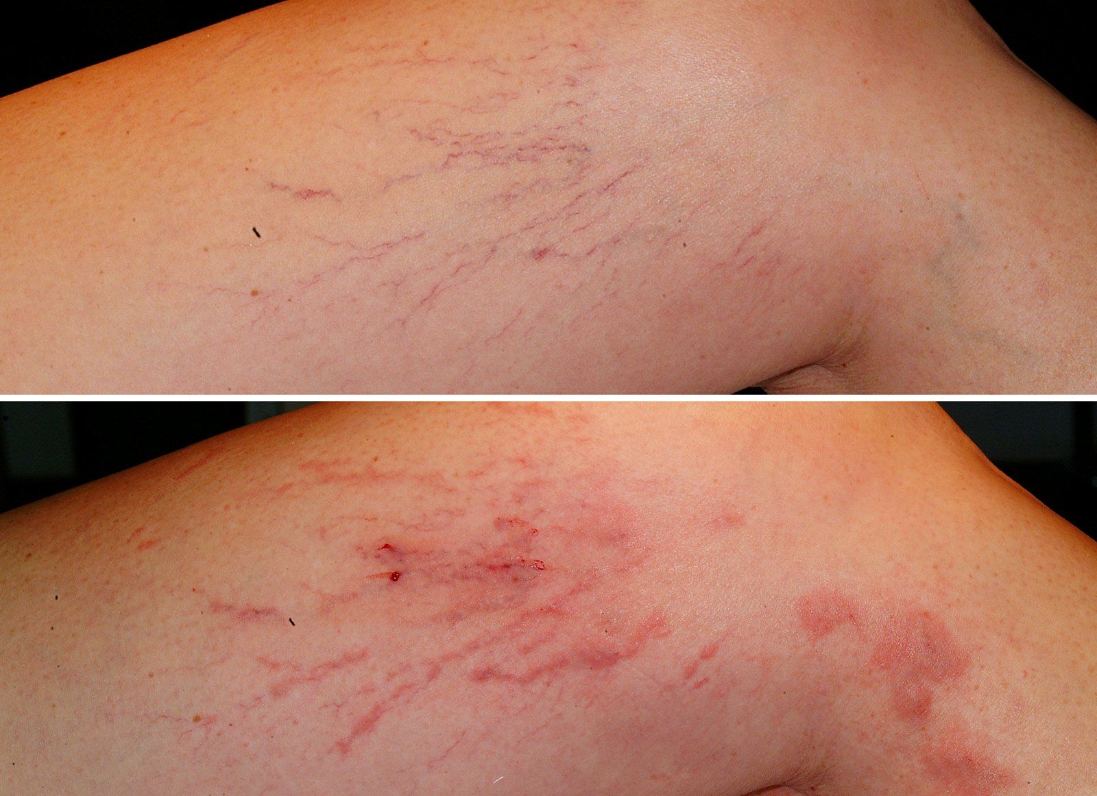 Before and after Vein treatment: Leg veins. Before on the left, after on the right.