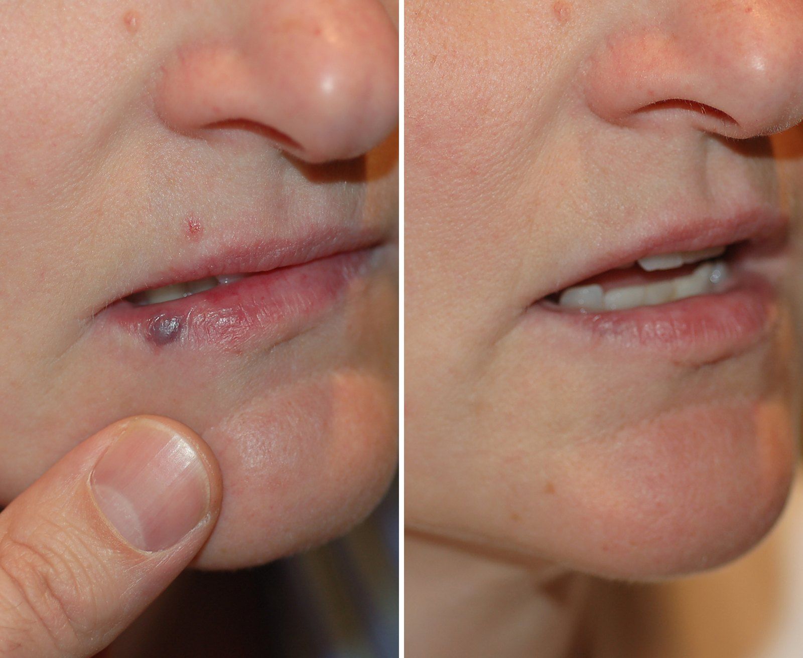 Before and after Vein treatment: Venous lake on the lip, laser. Before on the left, after on the right.