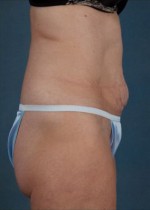 Smartlipo