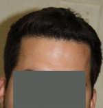 Hair Restoration