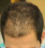 Hair Restoration