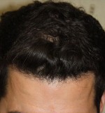 Hair Restoration