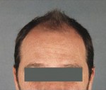 Hair Restoration