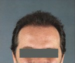 Hair Restoration