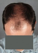 Hair Restoration