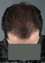 Hair Restoration