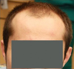 Hair Restoration