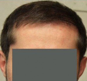 Hair Restoration