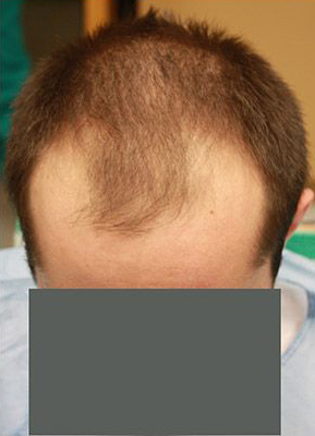 Hair Restoration