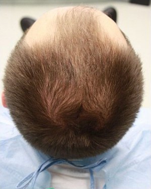 Hair Restoration