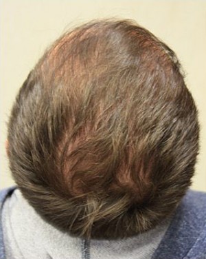 Hair Restoration