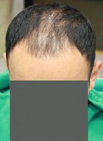 Hair Restoration