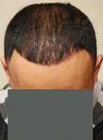 Hair Restoration