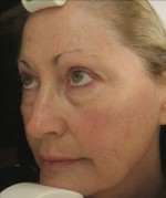 Facial Rejuvenation