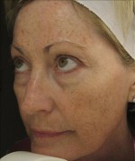 Facial Rejuvenation