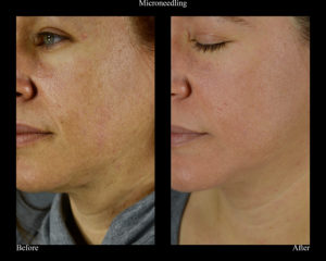 before and after microneedling