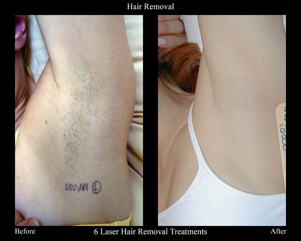 Laser Hair Removal Before & After Photos | MedSpa Redlands