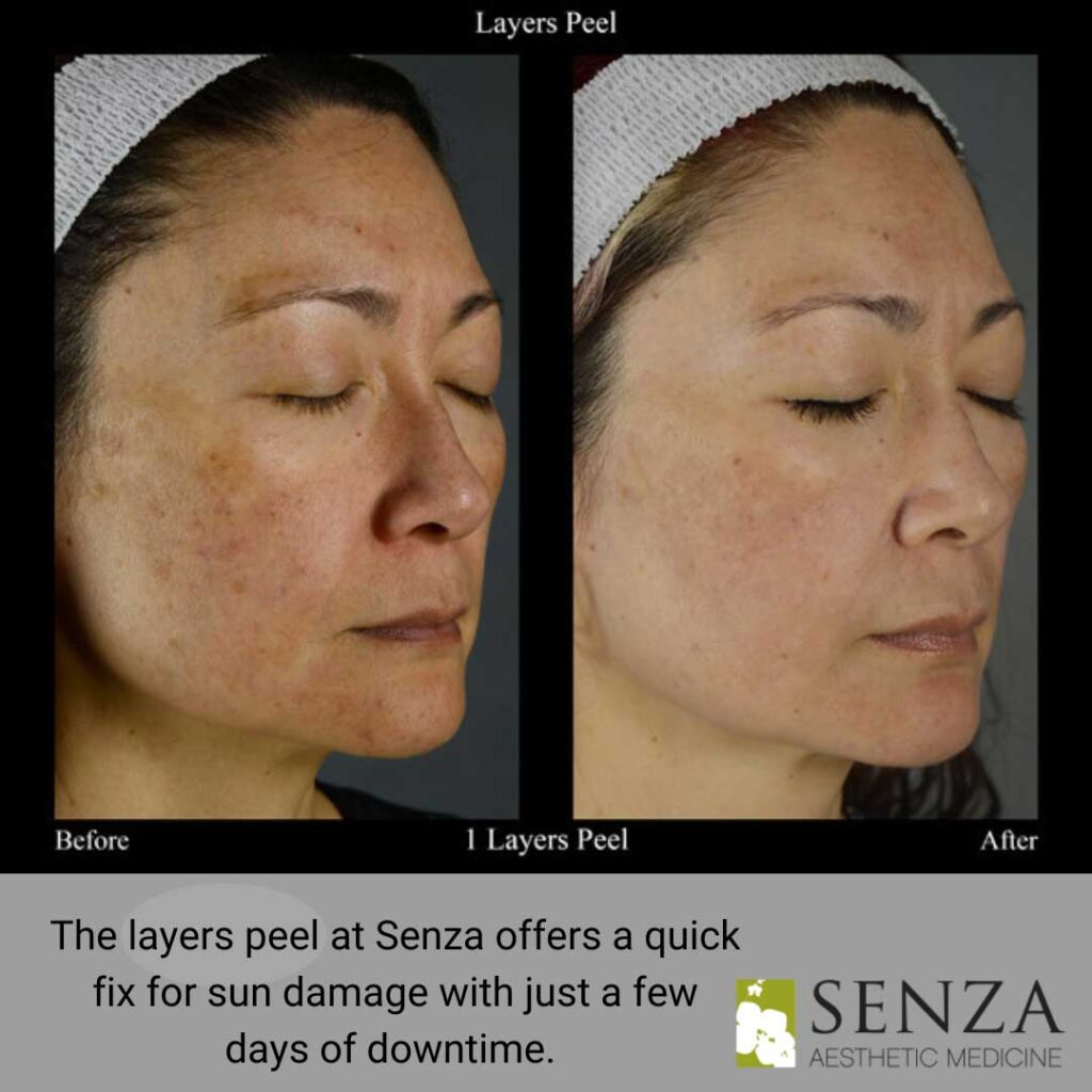 Microneedling vs. Chemical Peels Charting Your Course to Radiant Skin